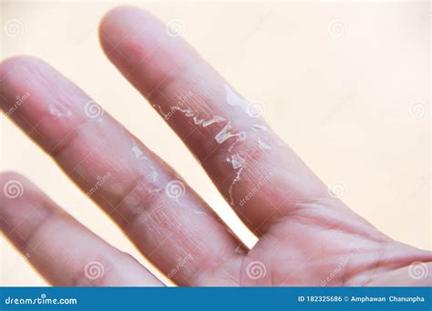 Asian Woman Palm Right with Flaky Peeling on the Ring Finger Hand , Allergic To Dish Washing ...