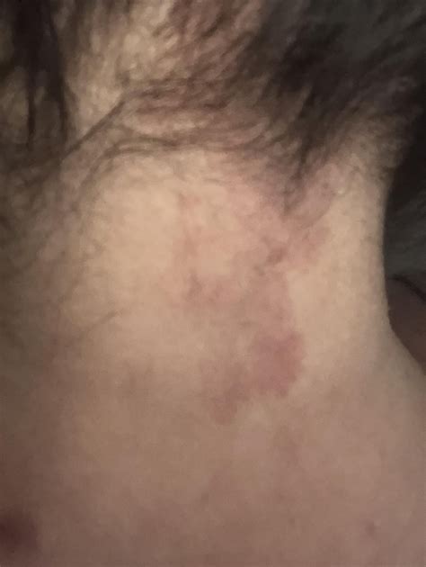 Neck stiffness and pressure - what's this bruising? : r/DiagnoseMe