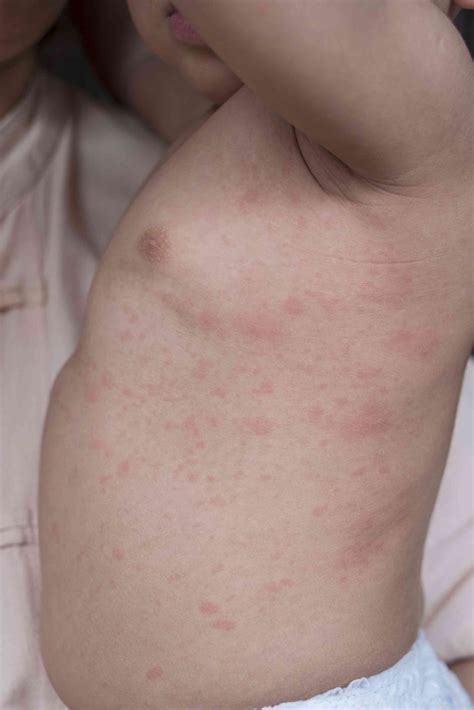 16 Causes of Viral Rashes With Pictures