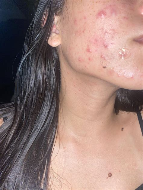 [acne] Benzoyl peroxide ruined my skin : r/SkincareAddiction