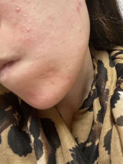 Gram Negative Folliculitis? - Acne - Acne.org Forum