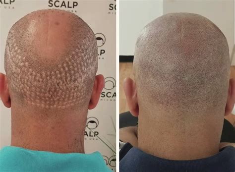 Scalp Inflammation After Hair Transplant at Nicholas Warrior blog