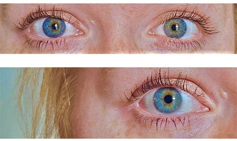 Central Heterochromia: Definition, Causes, and Types | Central heterochromia, Heterochromia ...