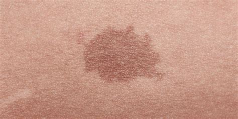 Birthmarks & Removal | Mesa, AZ | Sagebrush Dermatology