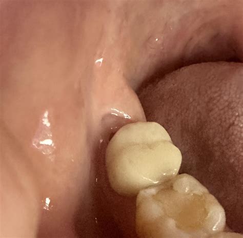 Hole in gum back molar where wisdom tooth is : r/wisdomteeth