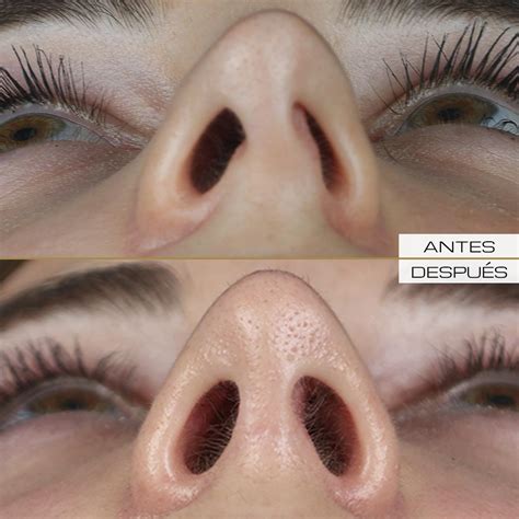 Rinoplastia Abierta – Dr. Ramón Terré