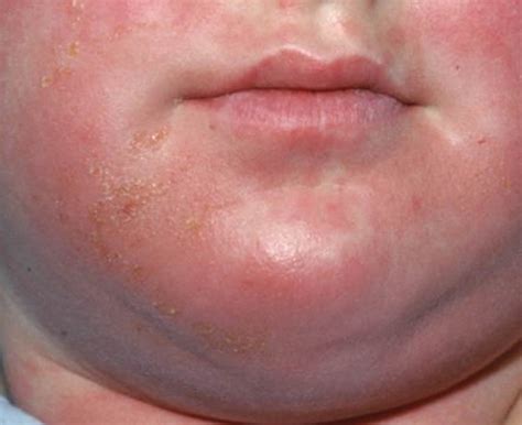 Poison Ivy Rash - Causes, How To Identify Poison Ivy Rash & Treatment