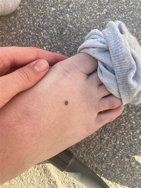 Why Do I Have Black Spots Under My Feet at Ryder Sturdee blog