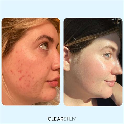 CLEARSTEM Skincare Review - Must Read This Before Buying