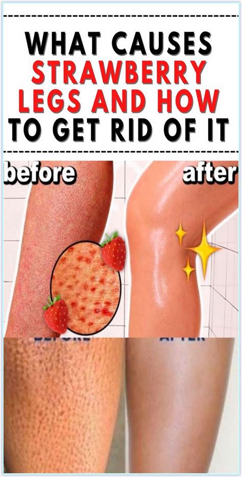 How to get rid of strawberry legs – Artofit