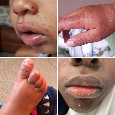 Hand Foot And Mouth Disease Rash On Buttocks Clearance ...