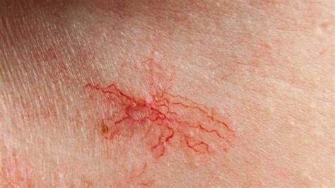 Understanding Broken Veins - Hough Green Clinic