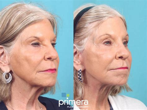 Mini Facelift Before and After Pictures Case 920 | Orlando, Winter Park & Tampa, Florida ...