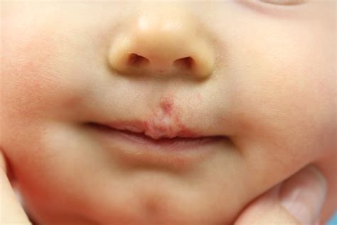 Strawberry Hemangioma Lip