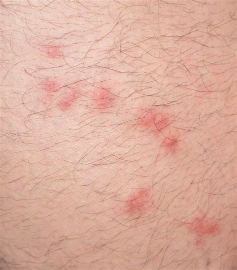 Tick Bite Rash Pictures Humans