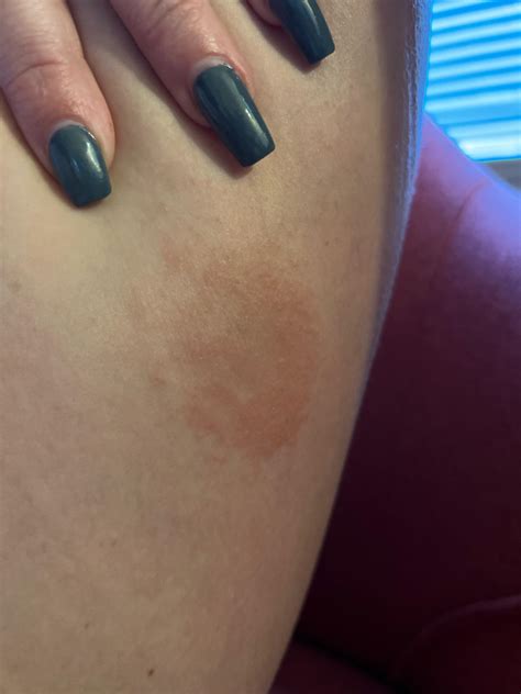 Itchy knot w bruise on leg? : r/DermatologyQuestions