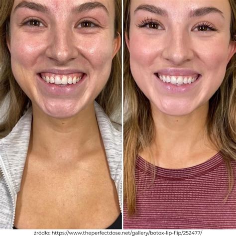 Lip Flip Botox - modelowanie ust bez wypełniaczy - Dermedik Kraków