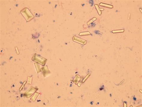 Amorphous Crystals In Human Urine at Carole Spears blog