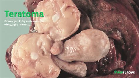 Teratoma Cancer Pictures