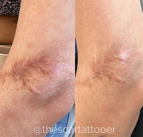Stretch Mark Camouflage Guide | DAELA Cosmetic Tattoo