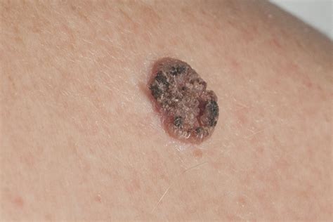 Black Raised Spot On Skin