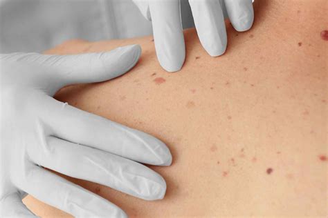 Poikiloderma Of Civatte