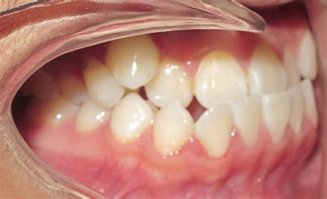 How Do Braces Fix Underbites? - Premier Orthodontics