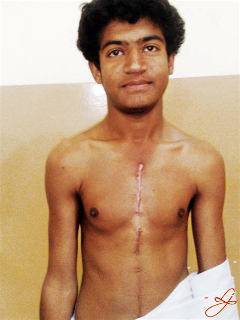 Open Heart Surgery Scar