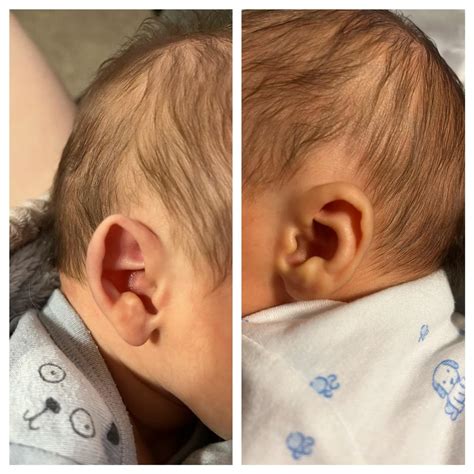 My newborn son has completely different shaped ears. : r/mildlyinteresting