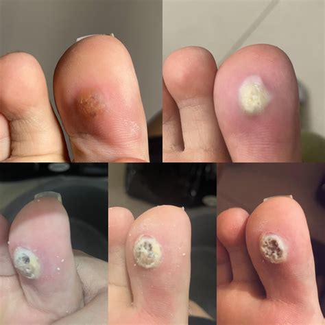 Wart progression: salicylic acid : r/Warts