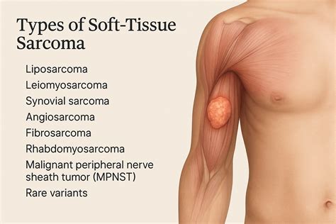 Soft-Tissue Sarcoma Symptoms, Diagnosis, Treatment | Ayurvedic Cure