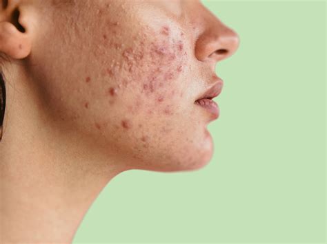 Acne Causes On Chin And Around Mouth