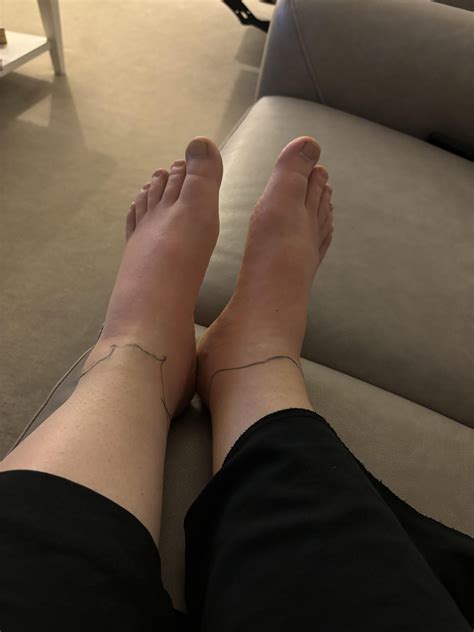 Swollen feet after wet walk : r/DermatologyQuestions