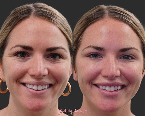 Botox Before and After Results - Everything You Need to See & Know