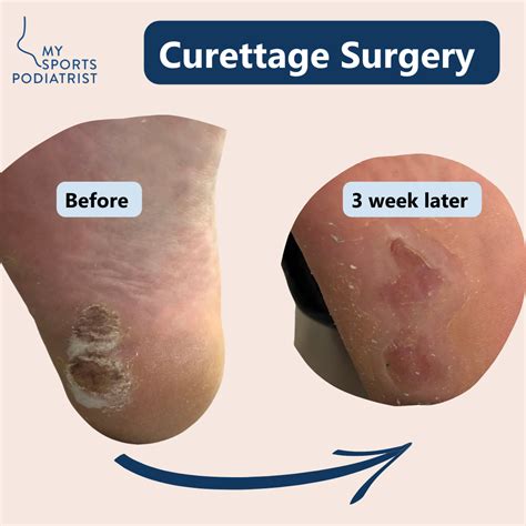 Plantar Wart Removal Surgery Aftercare at Latoya Zell blog