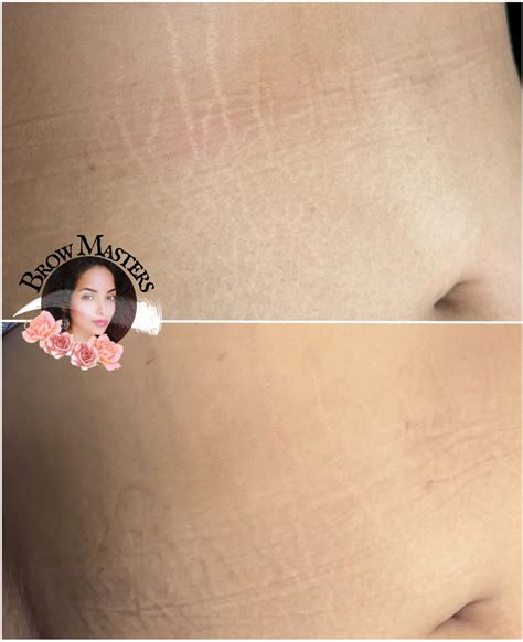 Stretch Mark Stomach Tattoos Project For Cover The Stretch Marks