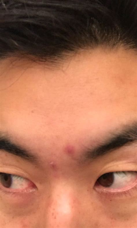 How To Heal Popped Pimples - Otherduty