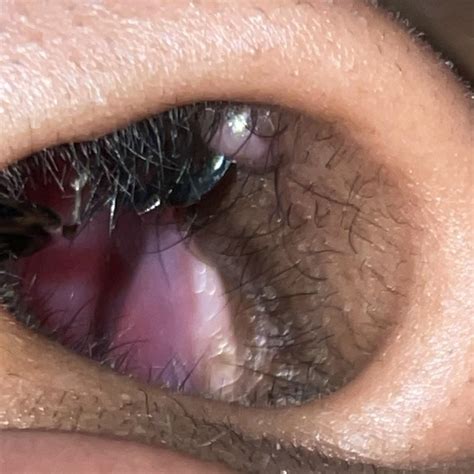 irritation bump inside my nose, how can i fix it? ive had this nostril ...