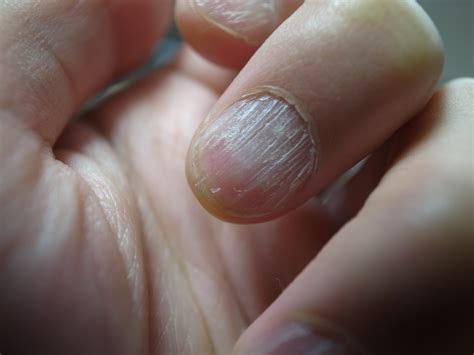 Fingernail Skin Peeling