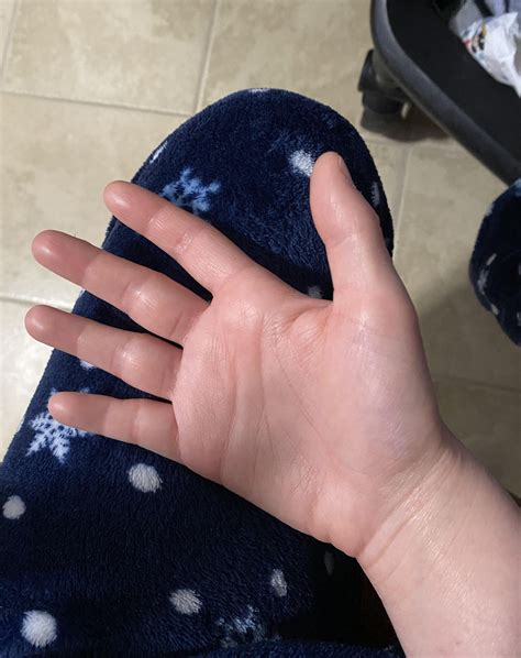 Anyone else get hand swelling? : r/ankylosingspondylitis