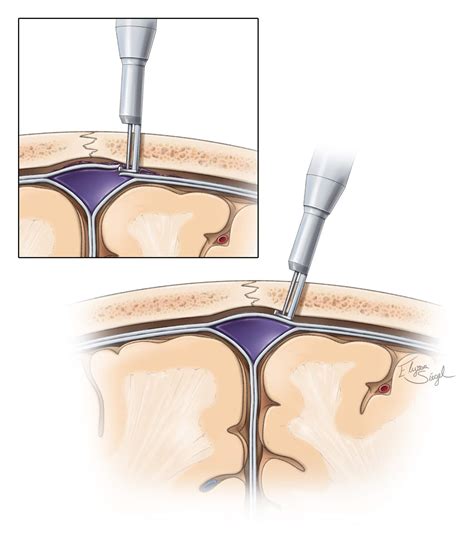 Burr Holes and Bone Flaps | The Neurosurgical Atlas