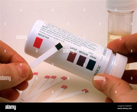 Abnormal urine glucose test. View of the hands of a general practice ...