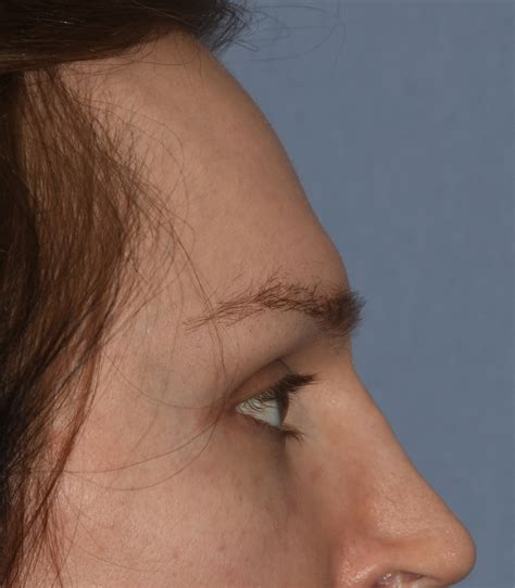 Prominent Brow Ridge Reduction