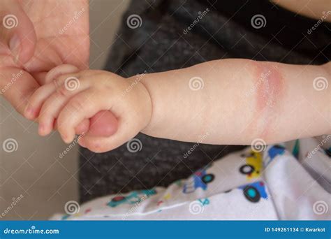 Prickly Heat. Close-up of the Folds of the Hand of a Newborn Baby with ...