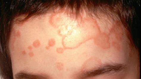 Treatment-resistant ringworm infections seen in U.S. | wltx.com