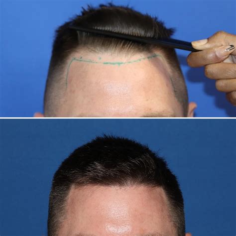 Dr. Bhumik Shah Bhumik Shah MD | 1180 FU grafts hairline lowering| New ...