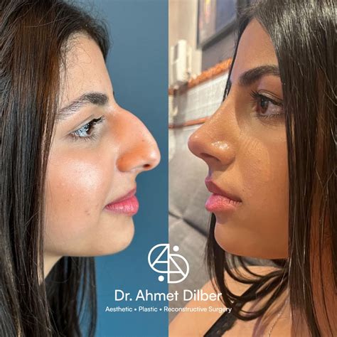 Rhinoplasty Result - Dr. Ahmet Dilber | Rhinoplasty nose jobs, Bad nose jobs, Rhinoplasty