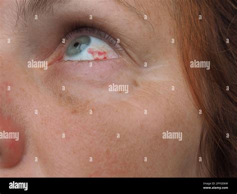 Subconjunctival hemorrhage or subconjunctival bleeding, hyposhagmus ...