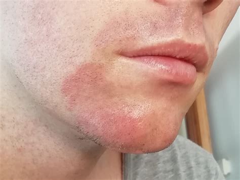 Redness around mouth/chin : r/Dermatology