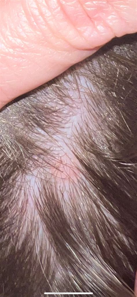 Lump on my scalp, anyone have any ideas? : r/DermatologyQuestions